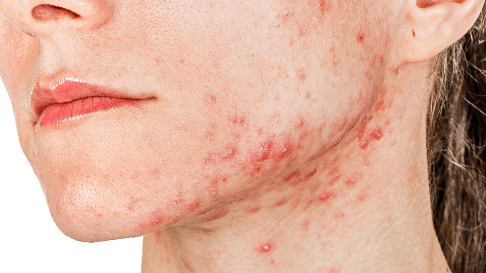 11 Ways to Get Rid of Acne Naturally