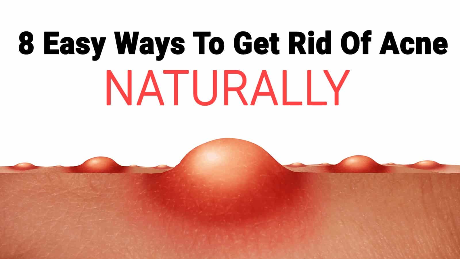 8 Easy Ways To Get Rid Of Acne Naturally