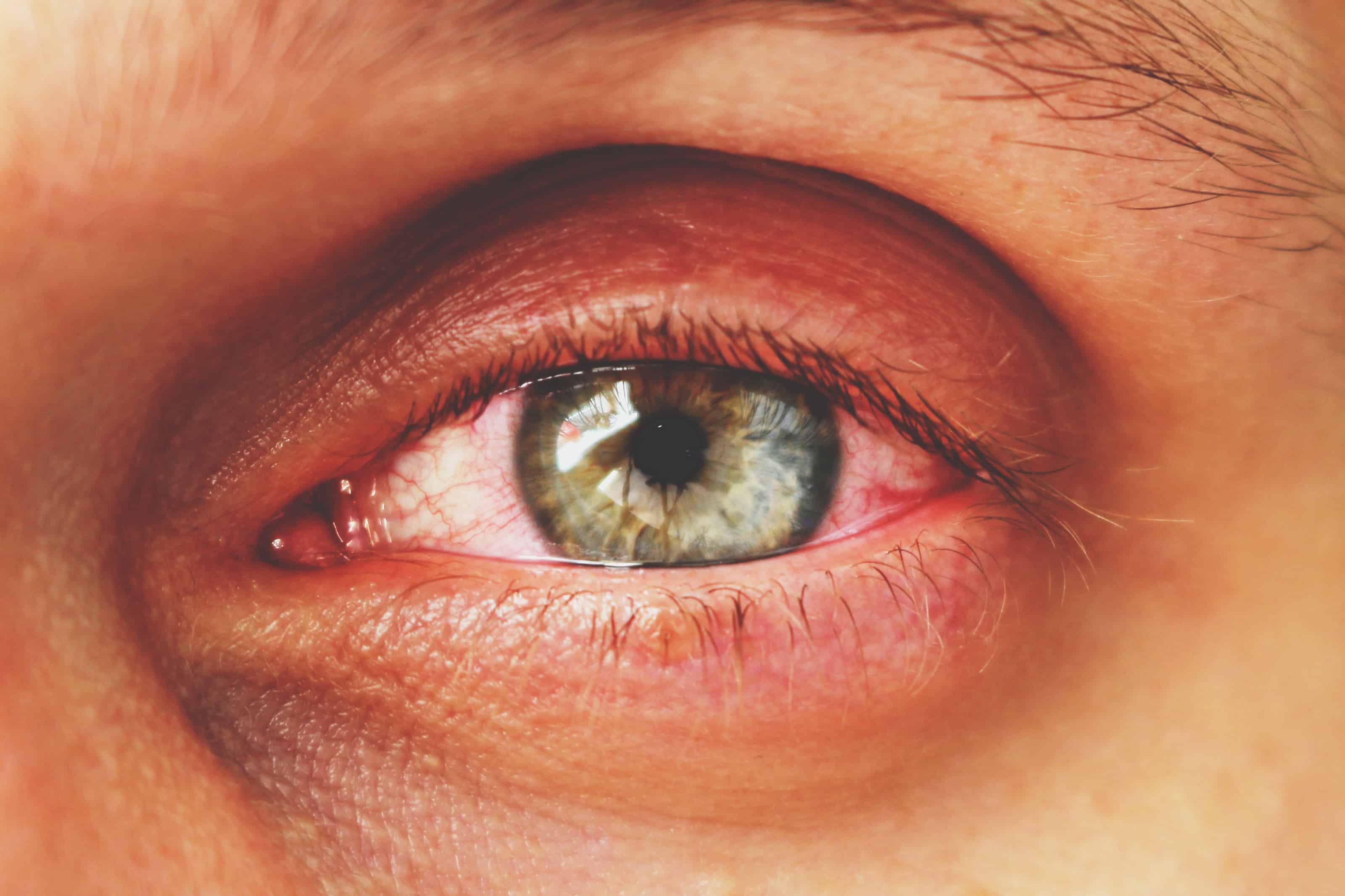 5 Signs You Are Getting Pink Eye