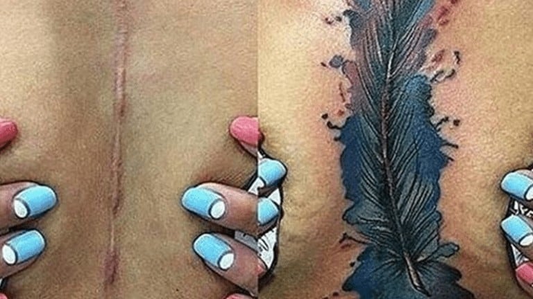 scars