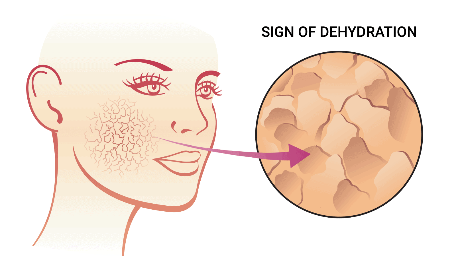 10 Early Signs You Are Becoming Dehydrated