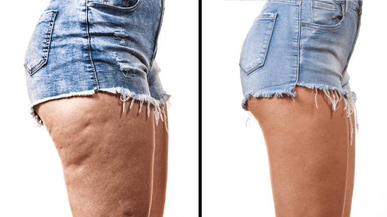 thigh fat