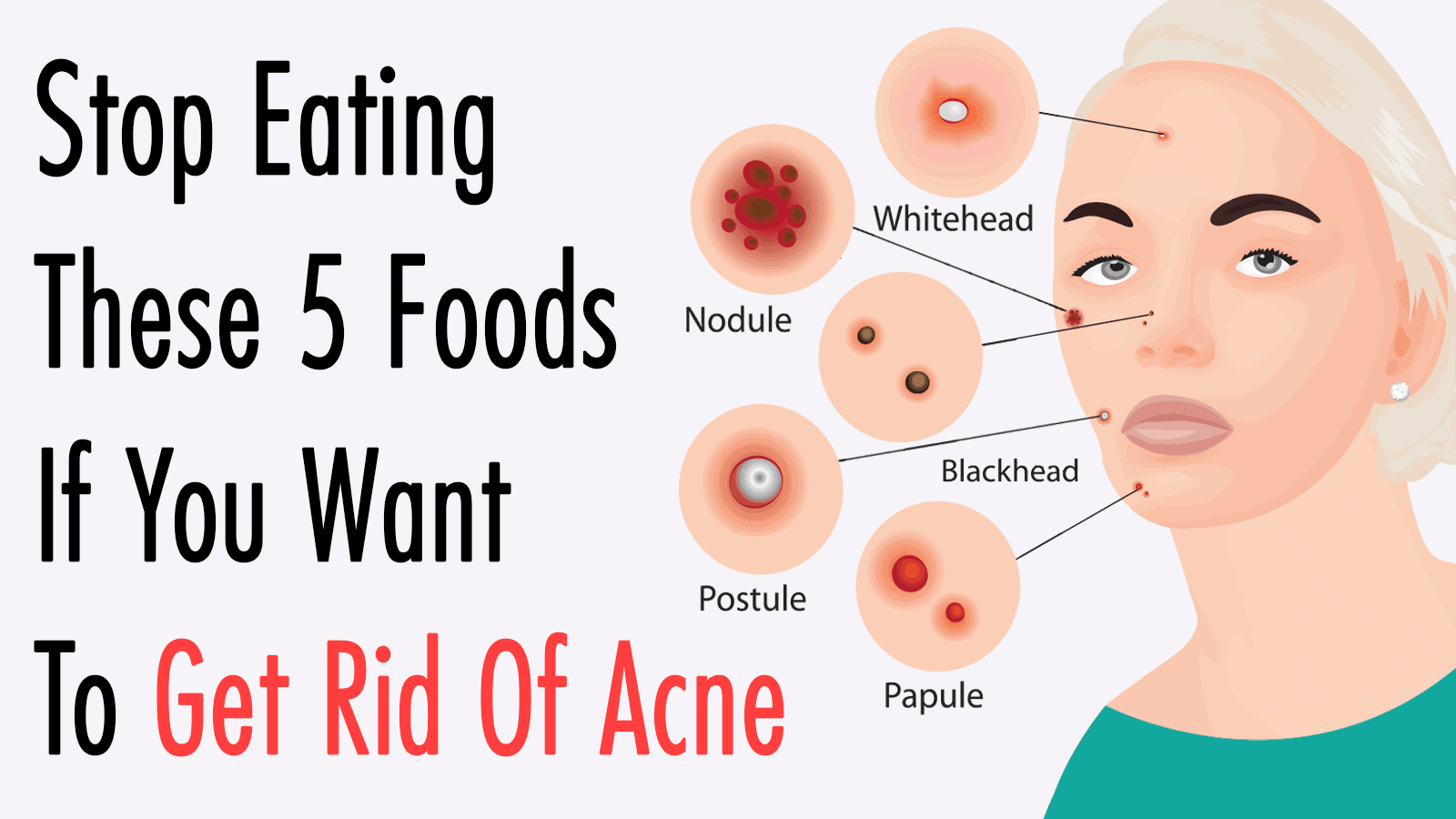 Stop Eating These 5 Foods If You Want To Get Rid Of Acne