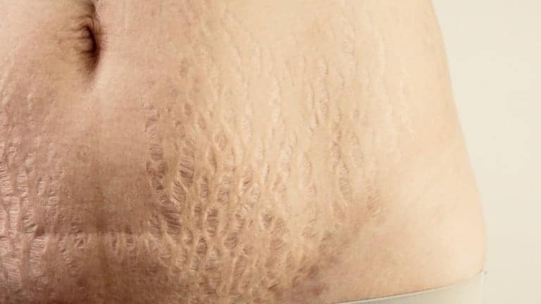 stretch marks