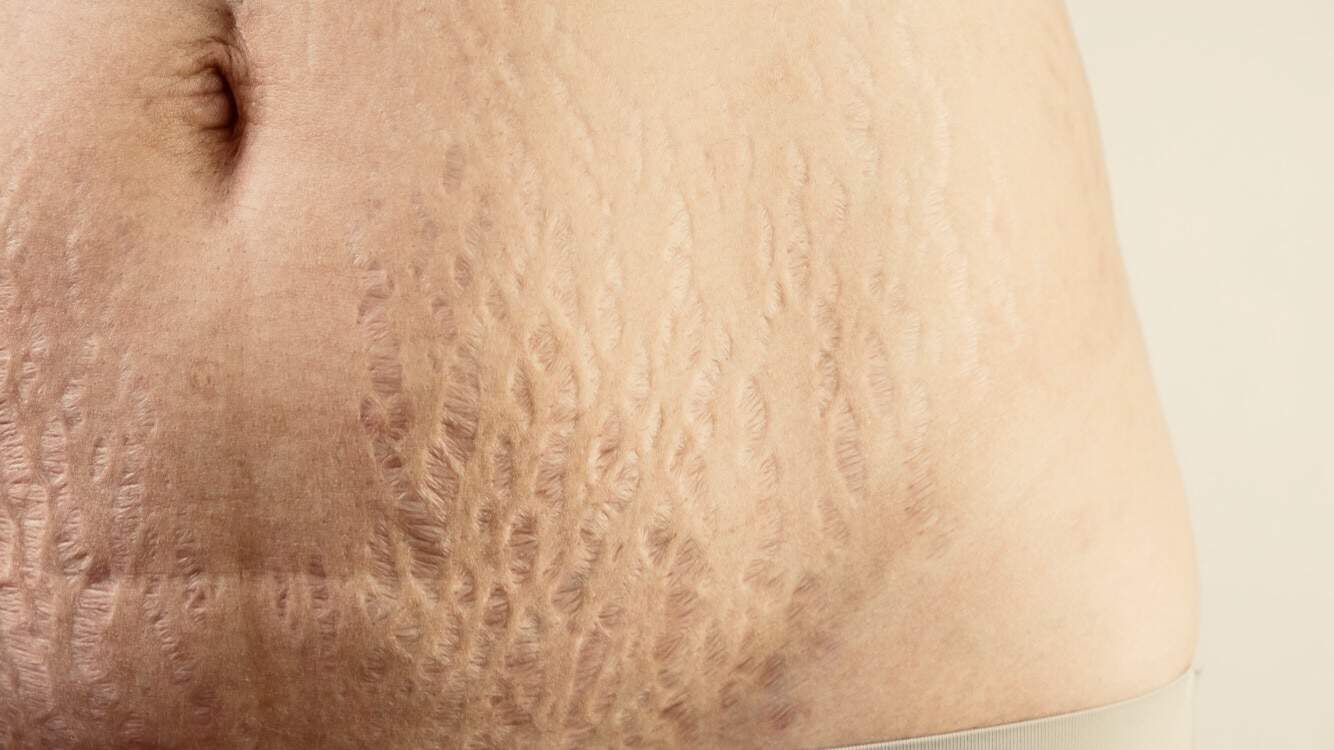 5 Natural Ways to Prevent Stretch Marks (And How to Get Rid of Them)