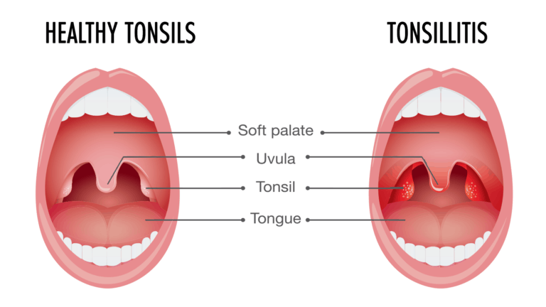 tonsillitis