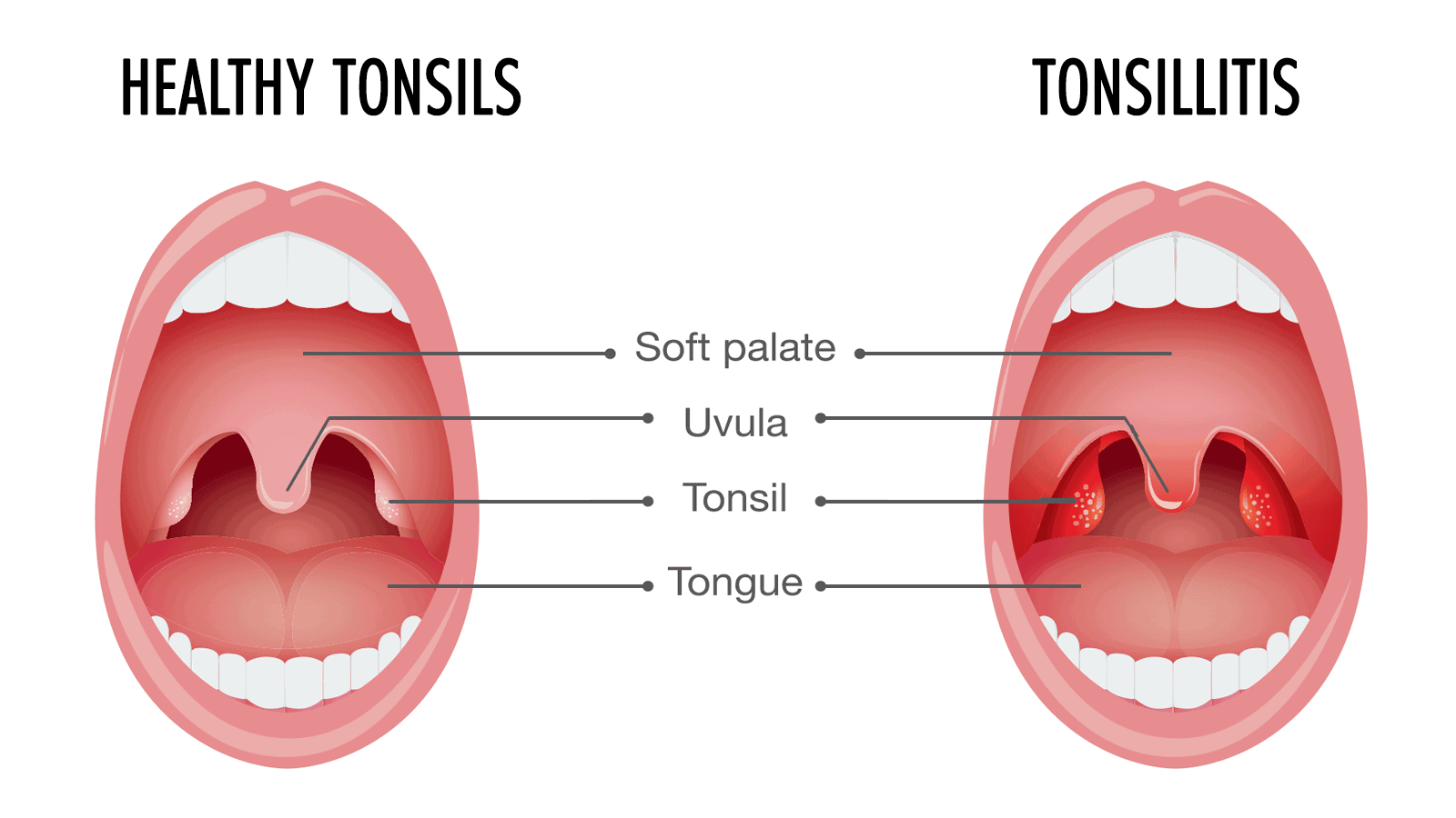 10 Early Signs of Tonsillitis (And How to Get Rid of It)