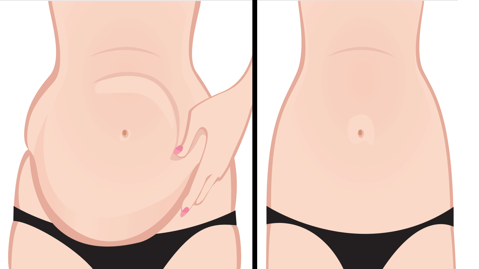 11 Ways to Get Rid of Belly Bloat Naturally