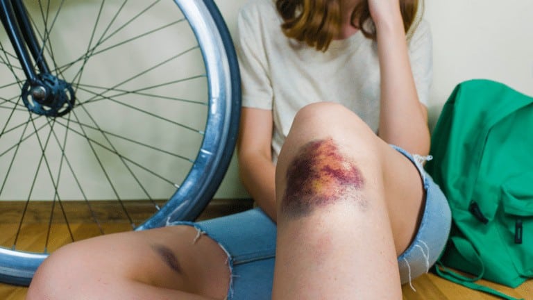 bruise easily