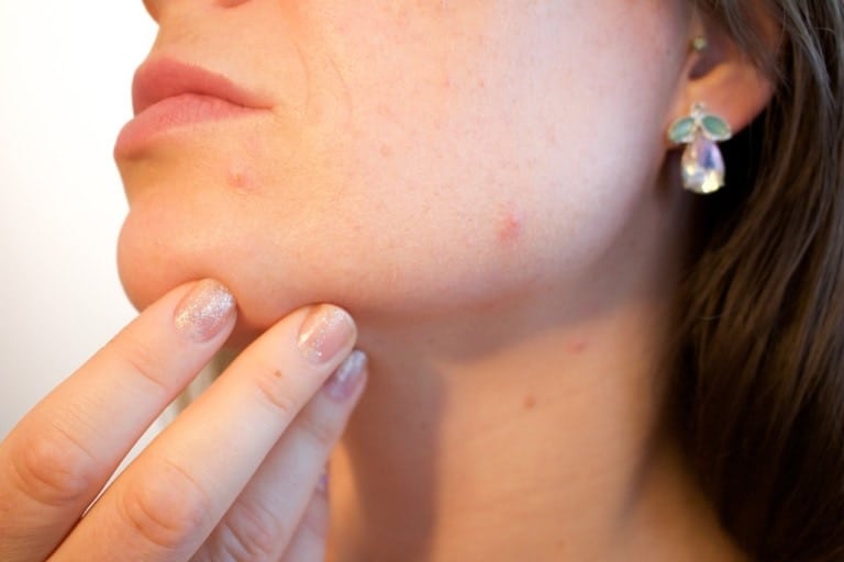 Remove acne
