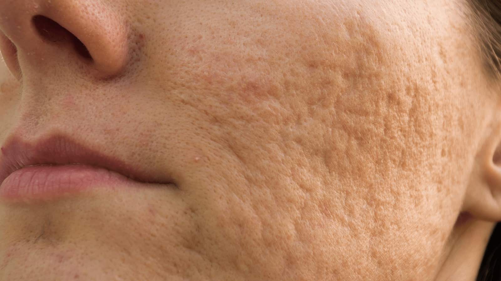 7 Effective Ways To Get Rid Of Acne Scars