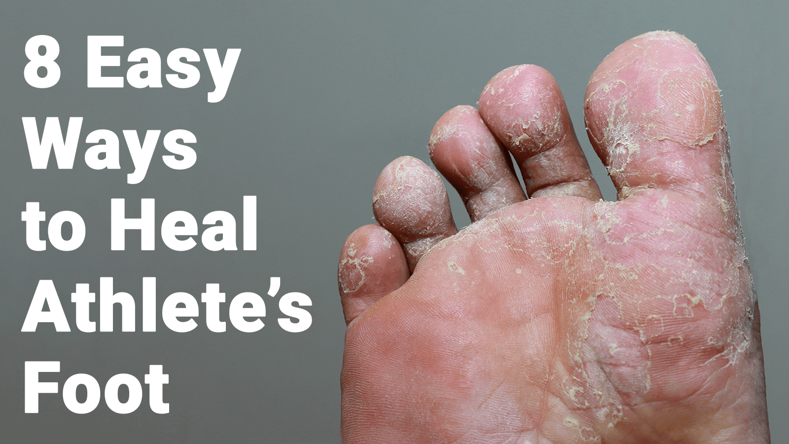 athlete-s-foot-what-is-it-and-how-to-prevent-it