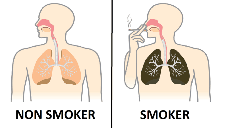 What Happens to Your Lungs When You Smoke