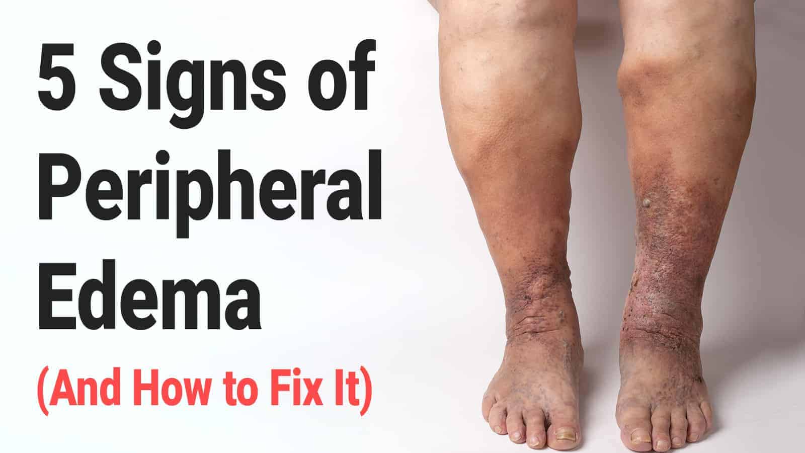 5 Signs of Peripheral Edema (And How to Fix It)