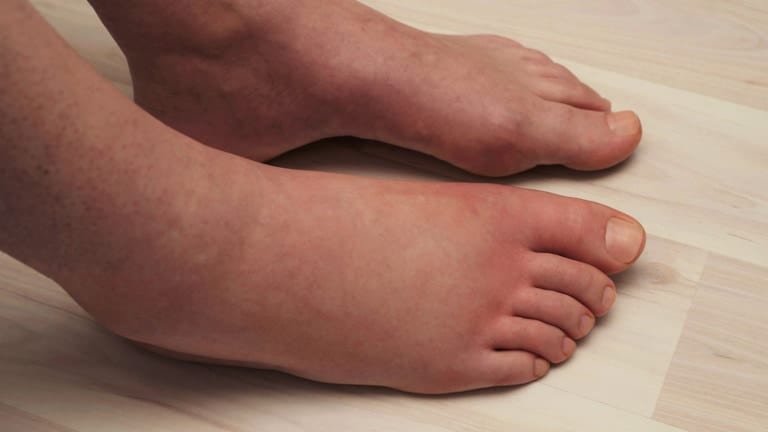 swollen legs