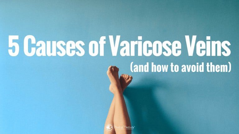 varicose veins