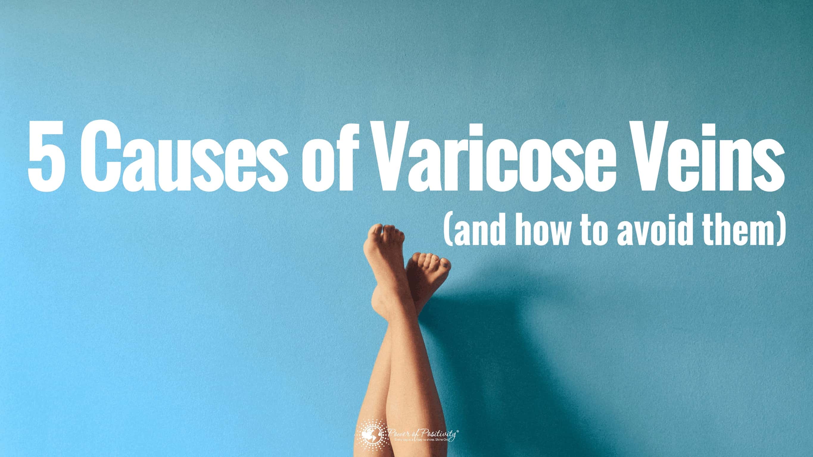 5 Causes of Varicose Veins (And How to Avoid Them)