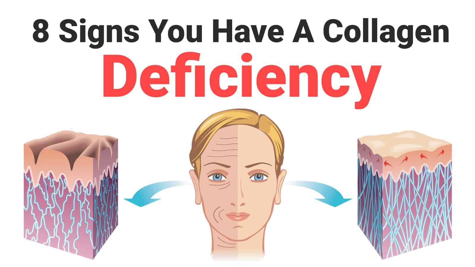 8 Signs You Have A Collagen Deficiency