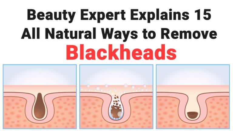 blackheads