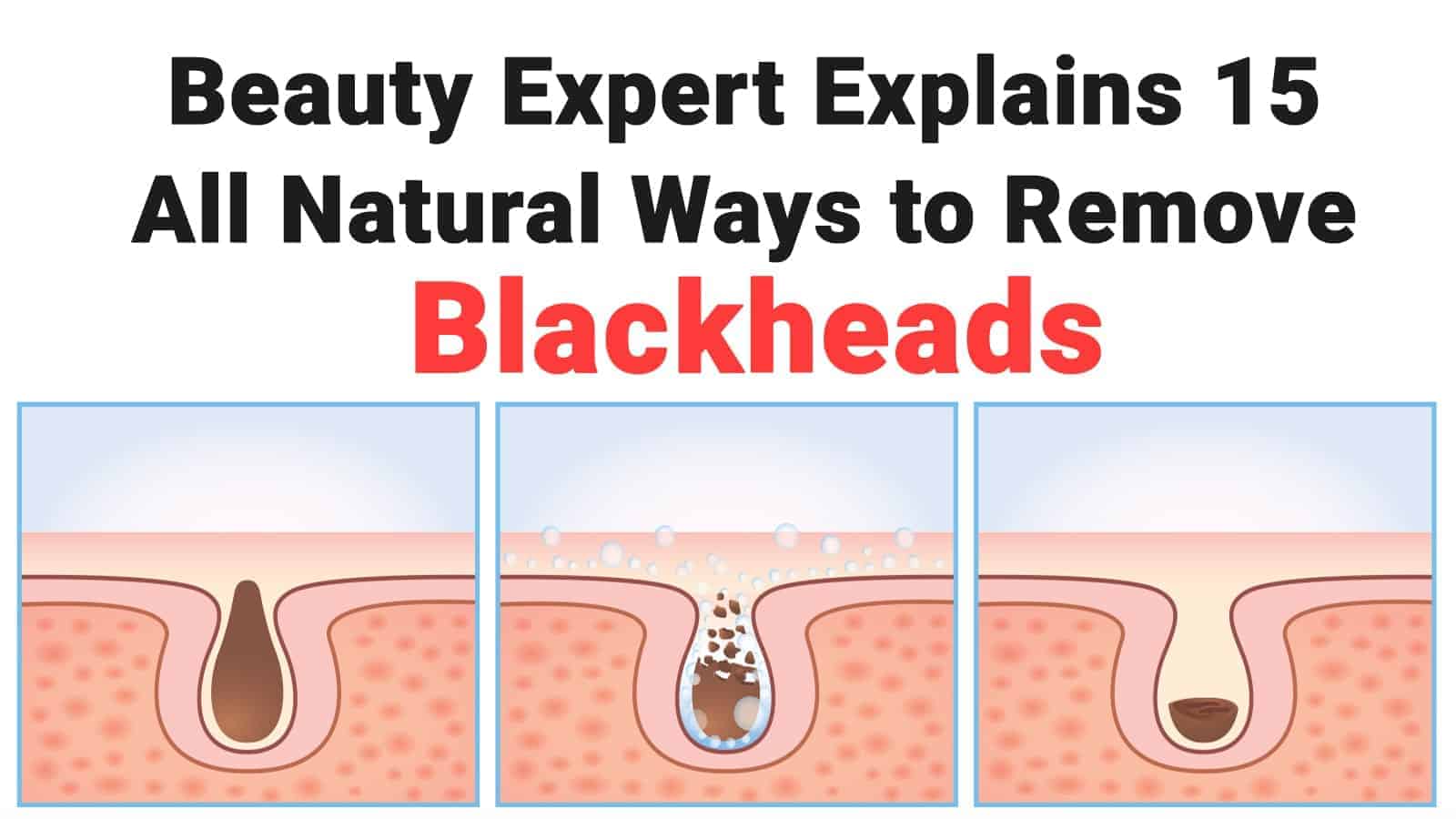 Beauty Expert Explains 15 All Natural Ways to Remove Blackheads