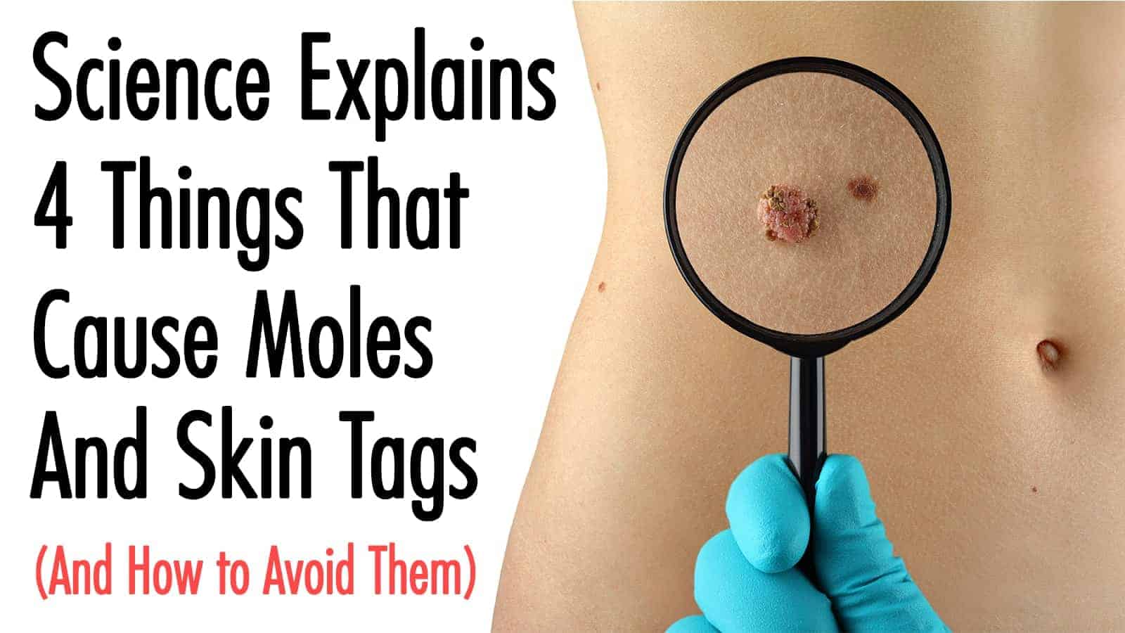 Science Explains 4 Things That Cause Moles And Skin Tags (And How to Avoid Them)