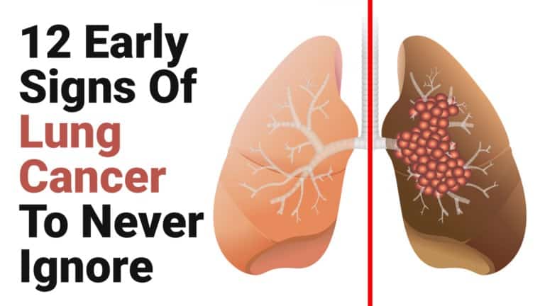 lung cancer