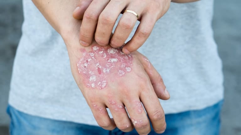 eczema