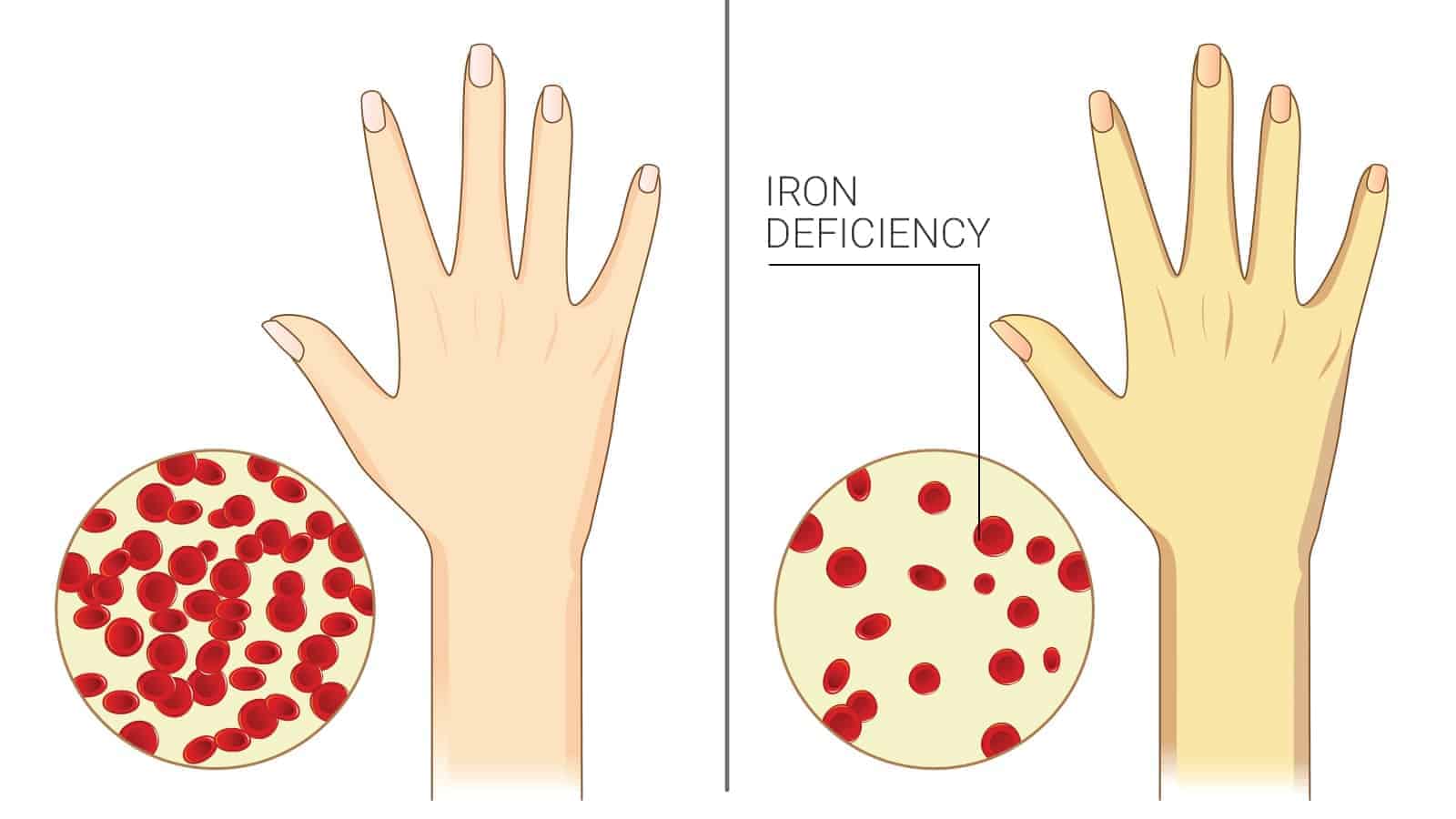 7 Signs of Chronic Iron Deficiency Most Women Ignore