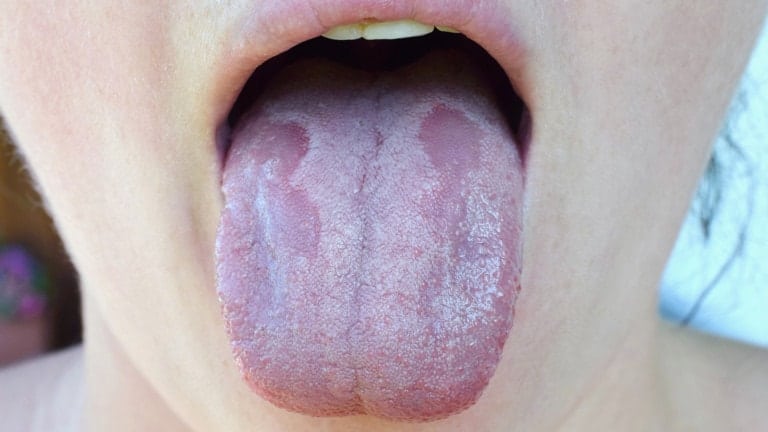 B12 deficiency