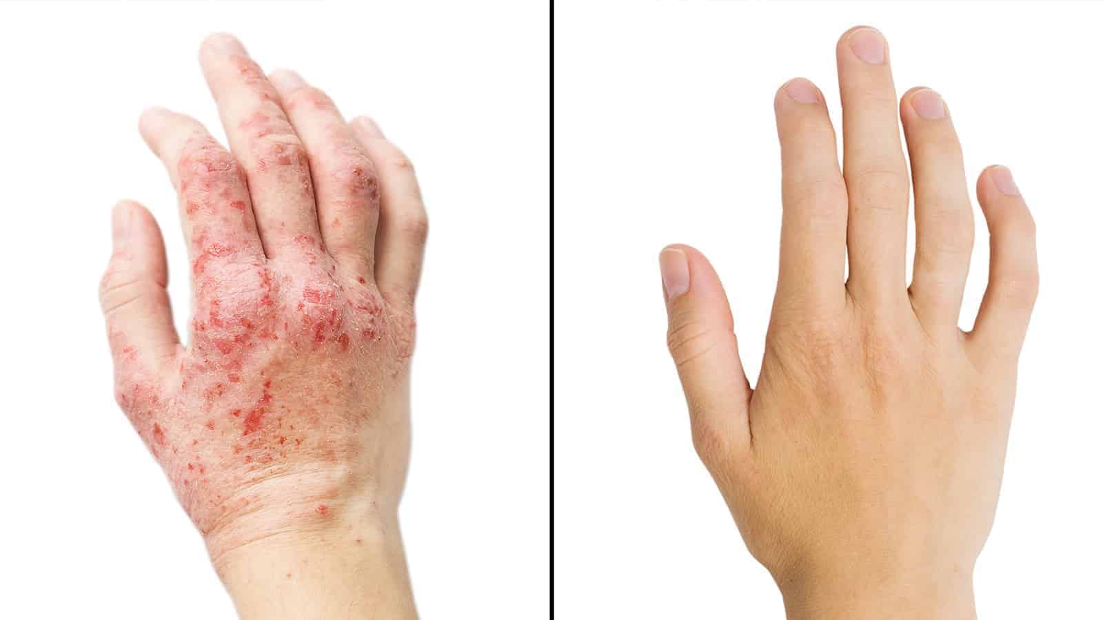 Researchers Reveal 15 Ways To Get Rid Of Eczema
