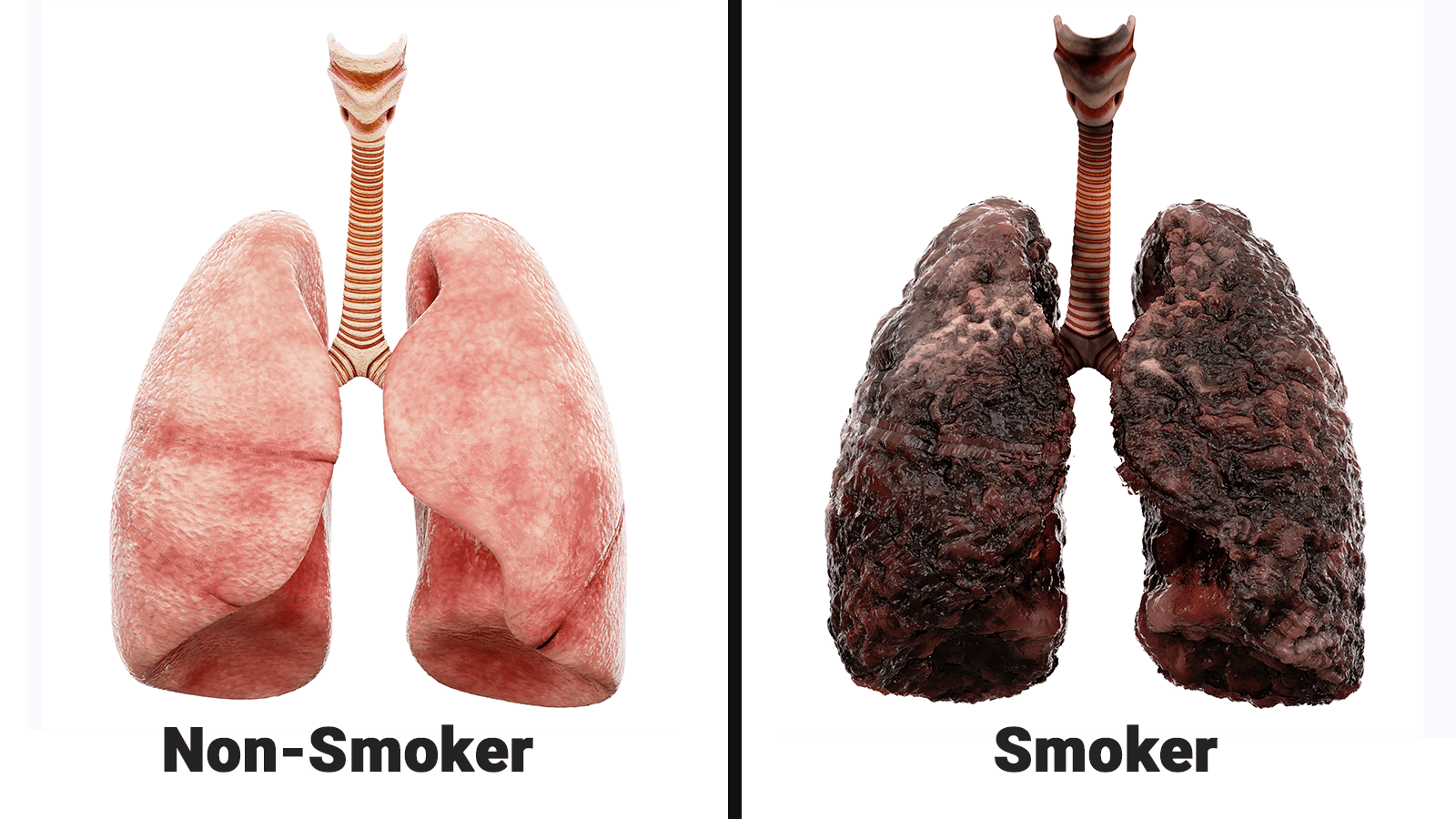 lung cancer