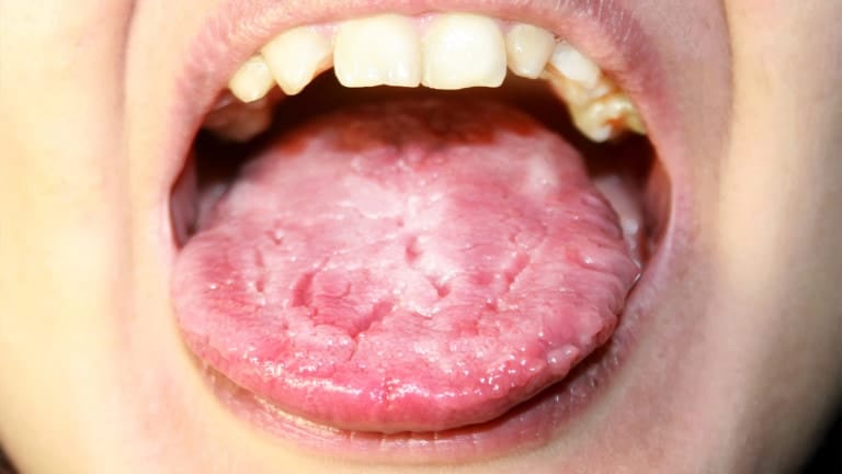 candida infection