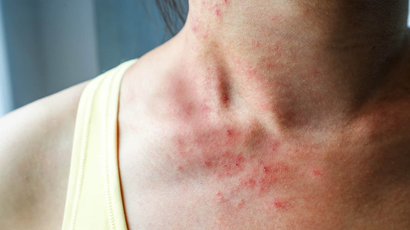 10 Things Itchy Skin Says About Your Health
