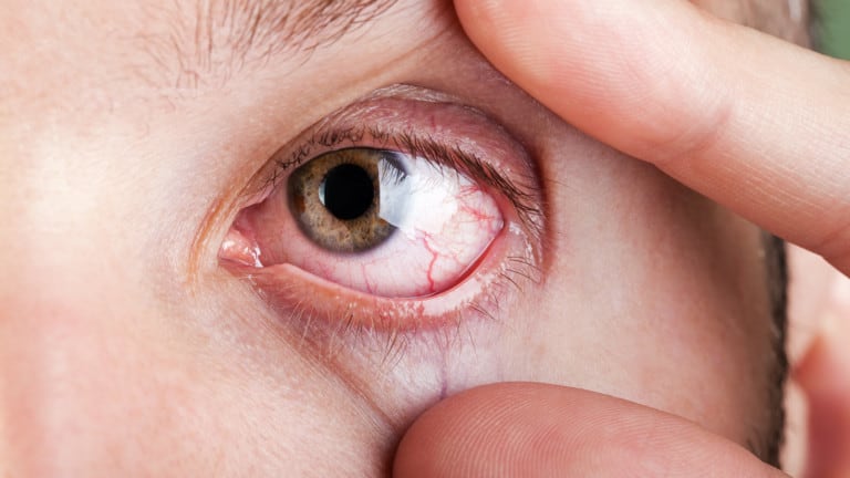 eye pain