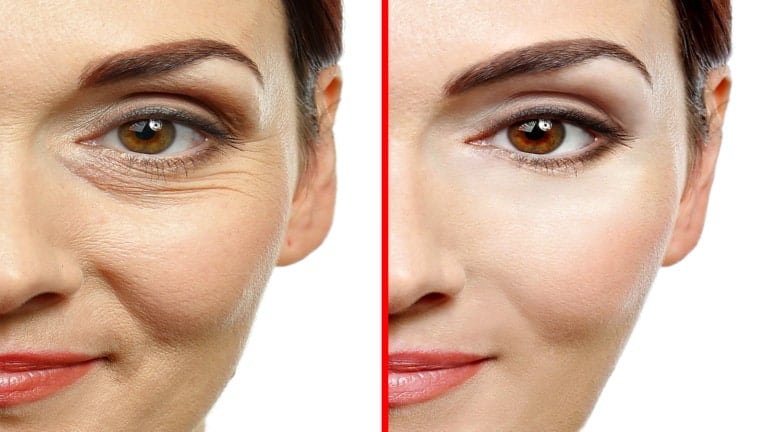botox