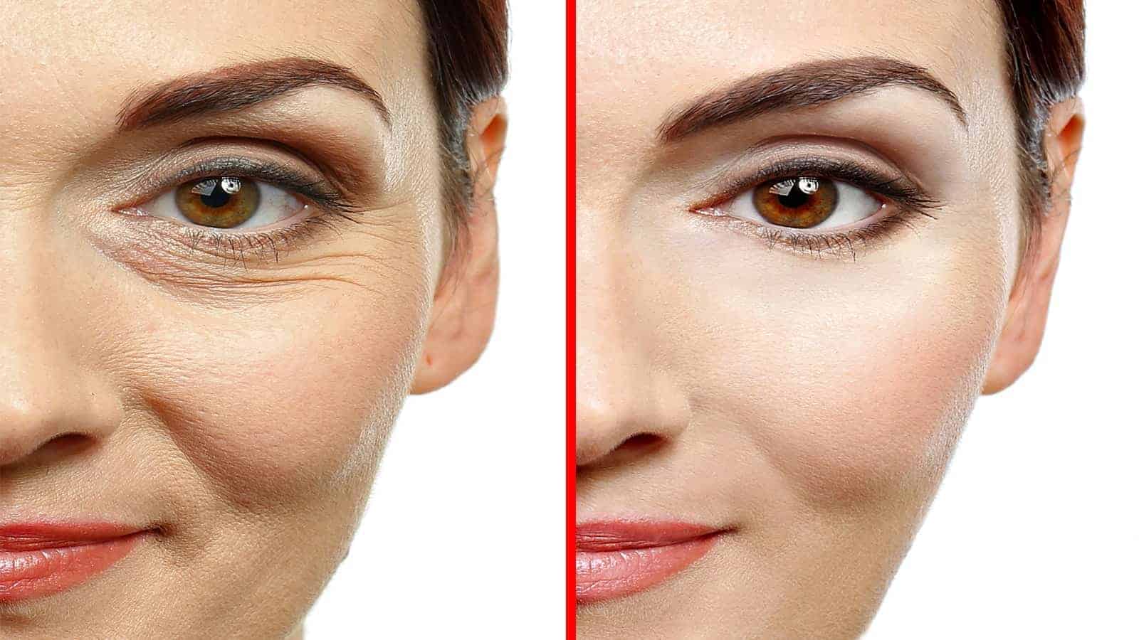 How to Make A Natural Botox With Only Three Ingredients