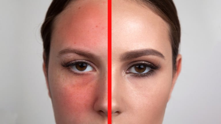 reduce redness