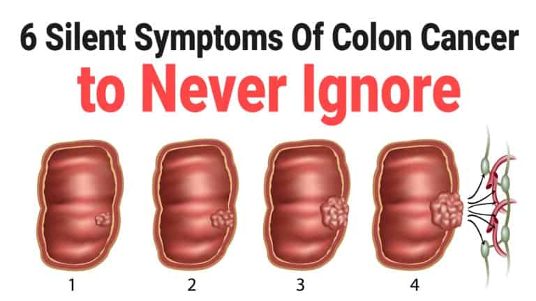 colon cancer