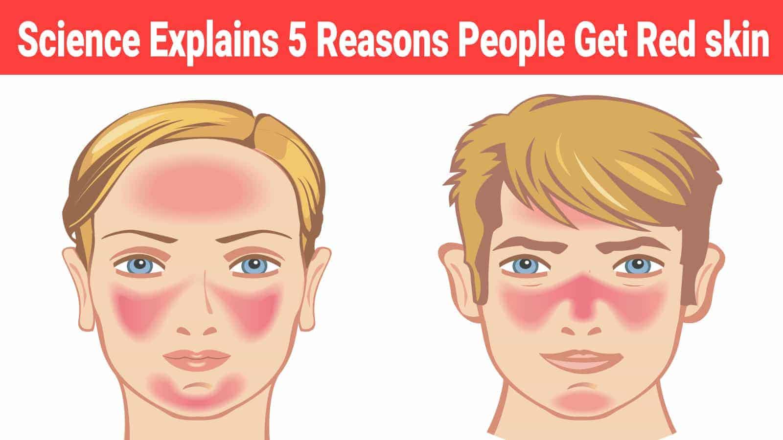 Science Explains 5 Reasons People Get Red skin