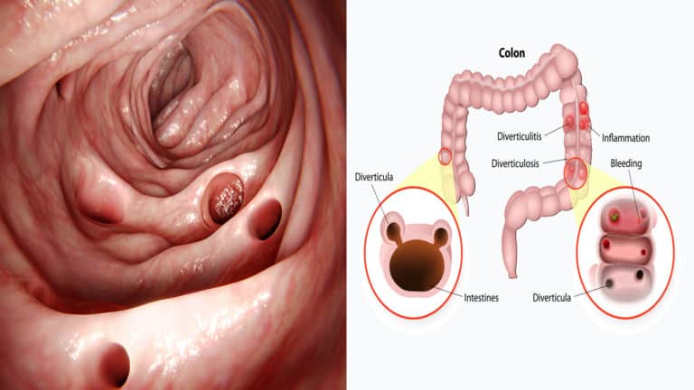 diverticulitis