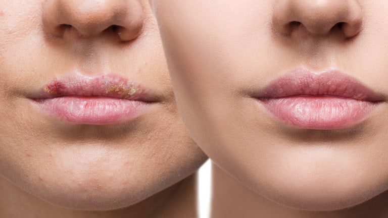 cold sores