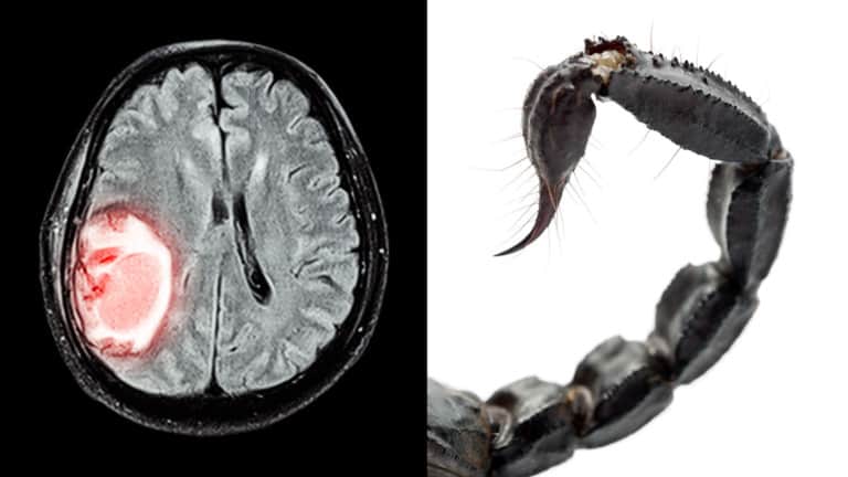 brain tumors