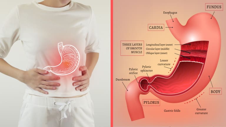 gastritis