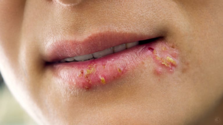 cold sores