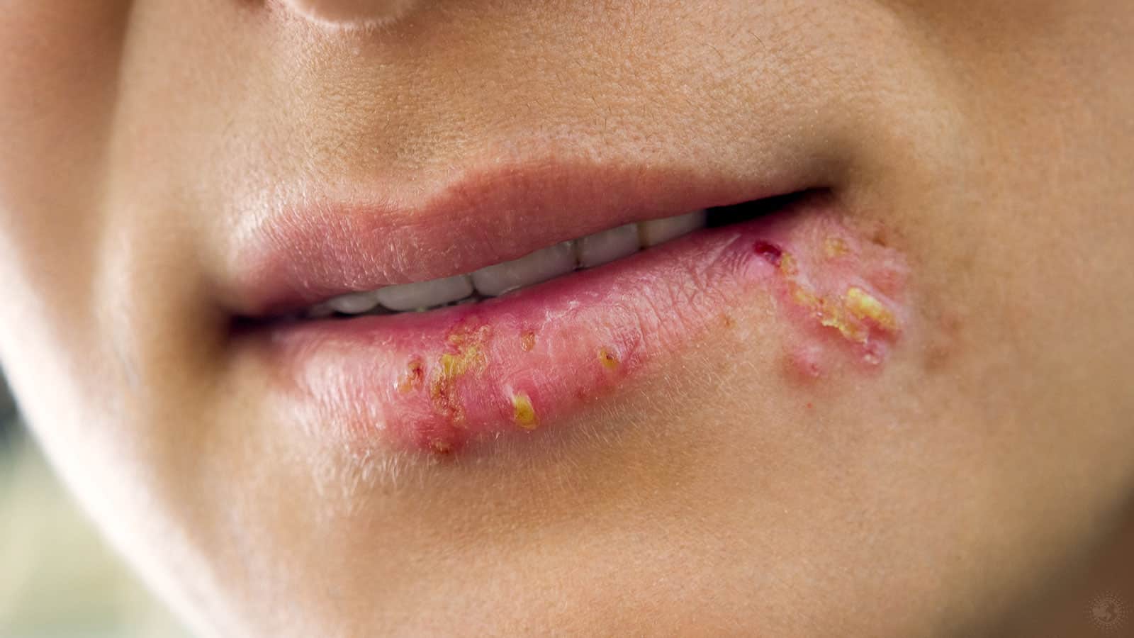 10 Ways to Relieve Cold Sores Naturally