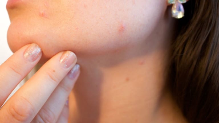 hyperpigmentation