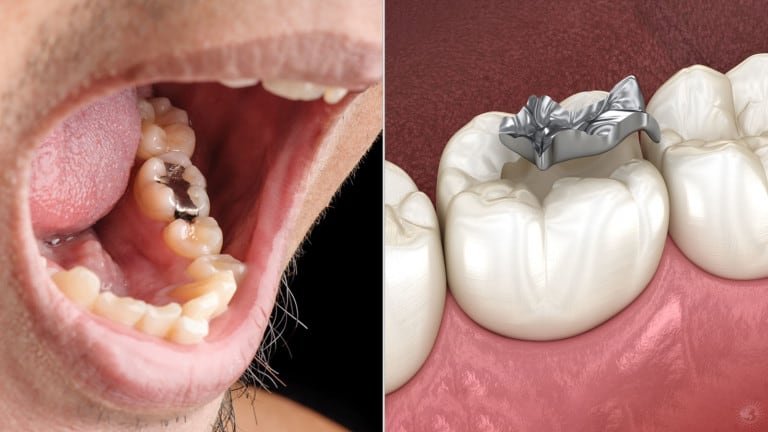 silver fillings