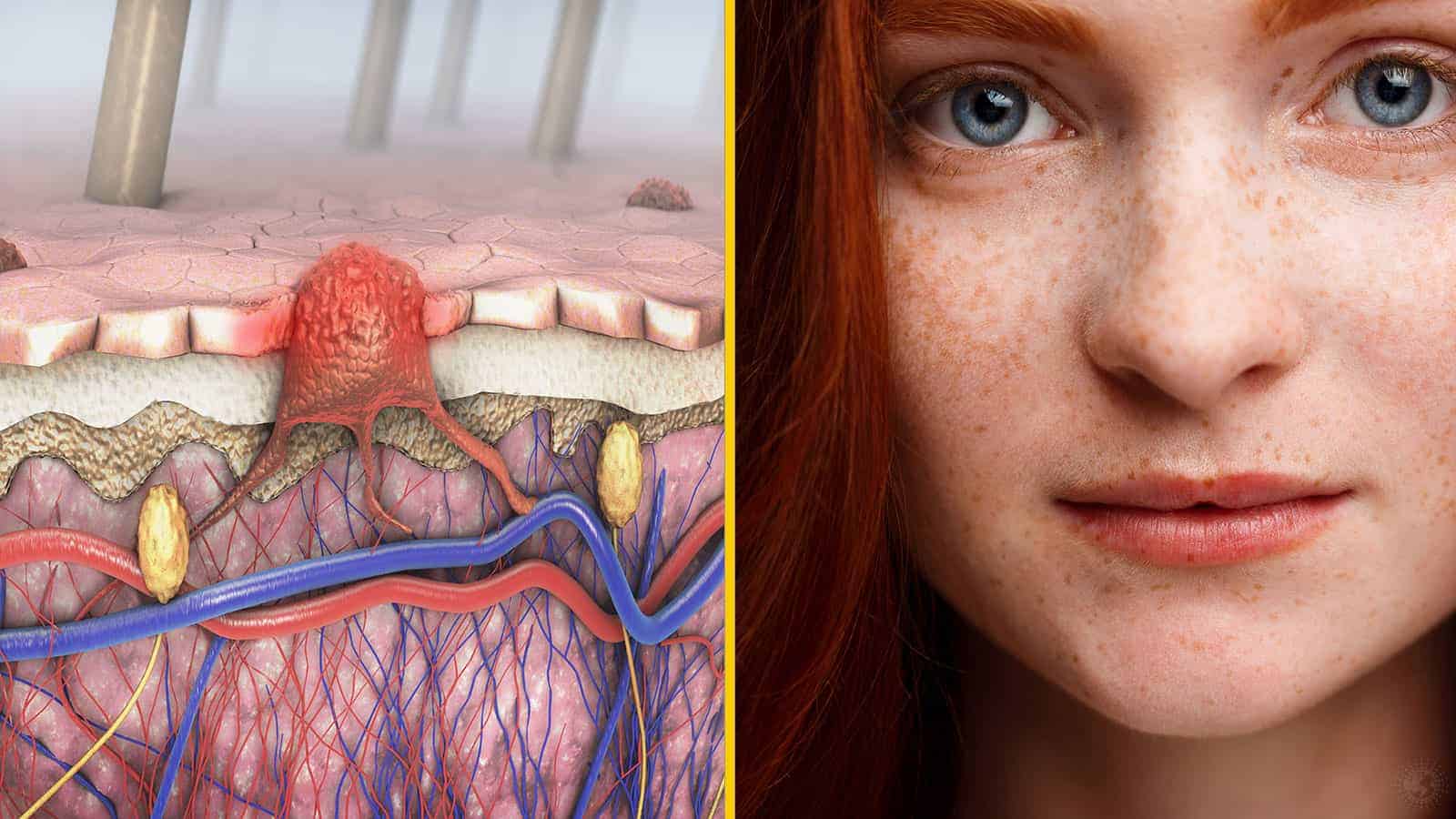 Researchers Reveal Why Red Hair Means You Have A Higher Risk For Skin Cancer