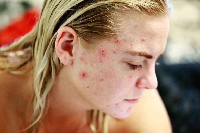 hyperpigmentation