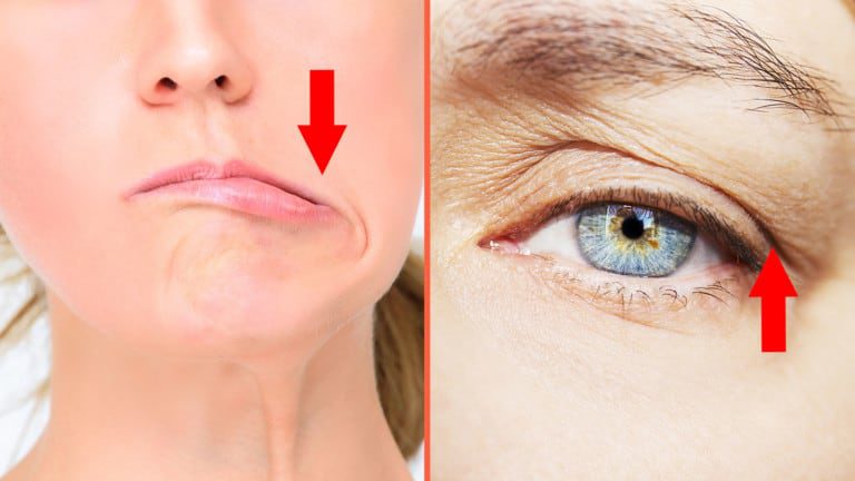 botox